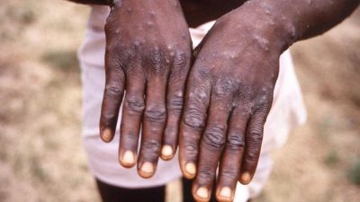 Kasus Cacar Monyet di Belgia Diduga Menyebar di Festival Gay